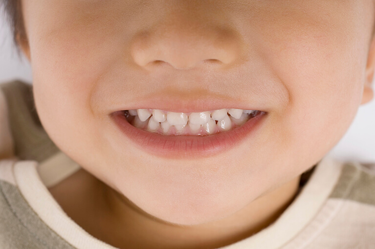 フッ素塗布は、生えたての乳歯や永久歯に高い予防効果を発揮します
